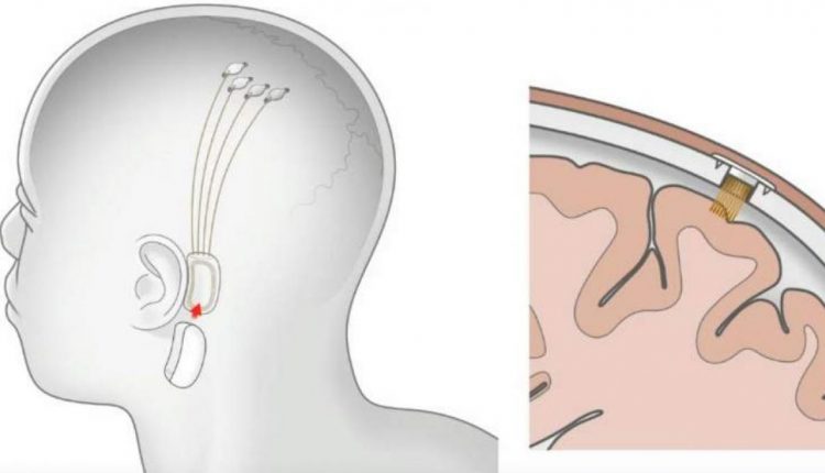 Neuralink Recibe Permiso De La FDA Para Hacer Implantes Cerebrales En